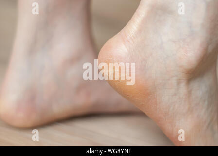 clavus and cracks on the heel of female foot close-up Stock Photo