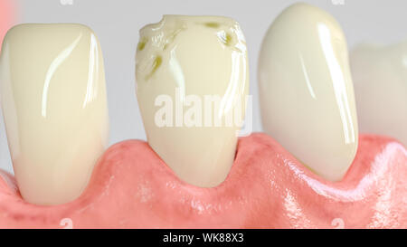 Tooth with caries attack in closeup - 3D Rendering Stock Photo
