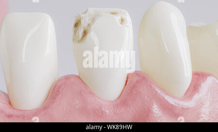 Tooth with caries attack in closeup - 3D Rendering Stock Photo