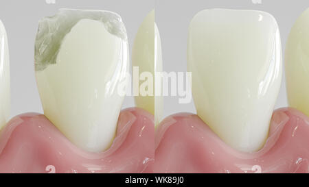 Tooth after caries treatment as closeup- 3D rendering Stock Photo