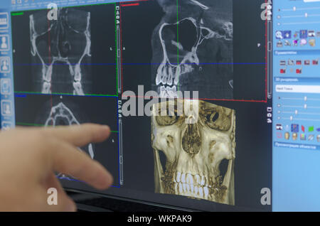 The doctor examines a X-ray examination of the maxillofacial region of the head on a computer monitor. Cone Beam Computed Tomography Stock Photo