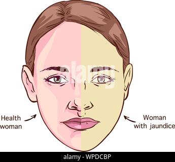 Jaundice. Comparison and difference of normal eye, and eye with icterus ...