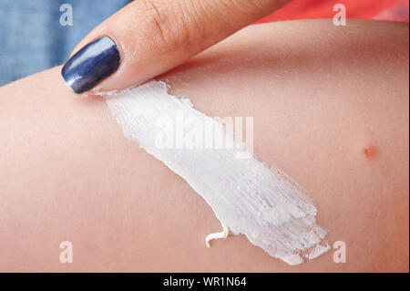 Applying white cream on skin scar with finger close up view Stock Photo