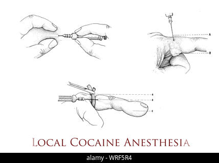 Local anesthesia with cocaine injection 19th century, cocaine was the first local anesthetic used for pain relief Stock Photo