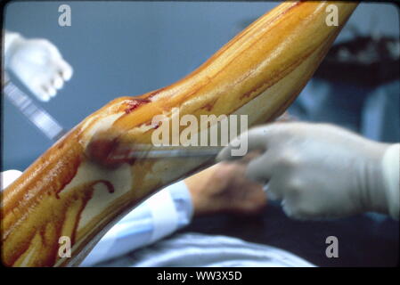 Surgeons performing knee replacement in sterile surgical scene.
