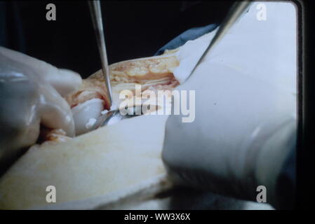 Surgeons performing knee replacement  in sterile surgical scene.