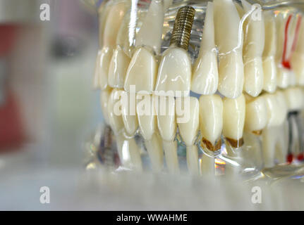 Transparent Model of Human Teeth with implants close-up Stock Photo