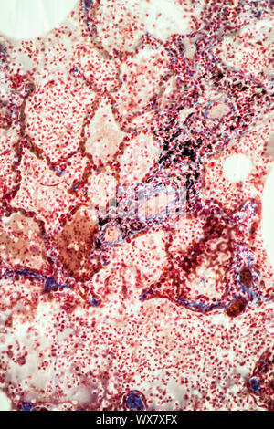 Pulmonary tuberculosis tissue under the microscope 100x Stock Photo