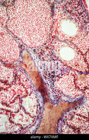 Pulmonary tuberculosis tissue under the microscope 200x Stock Photo