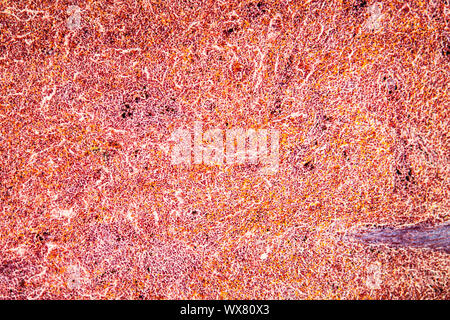 Malaria melanoma of the spleen Diseased tissue 100x Stock Photo