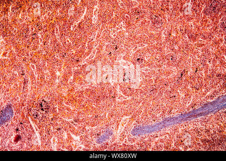 Malaria melanoma of the spleen Diseased tissue 100x Stock Photo