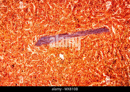 Malaria melanoma of the spleen Diseased tissue 100x Stock Photo