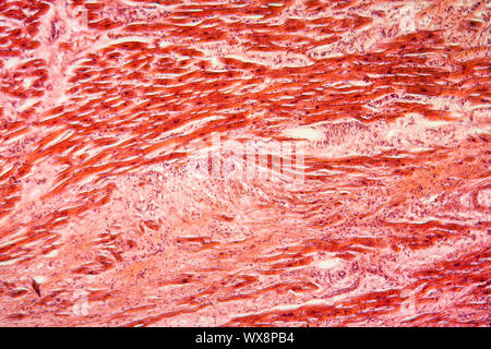 Cyst of the ovary diseased tissue 100x Stock Photo