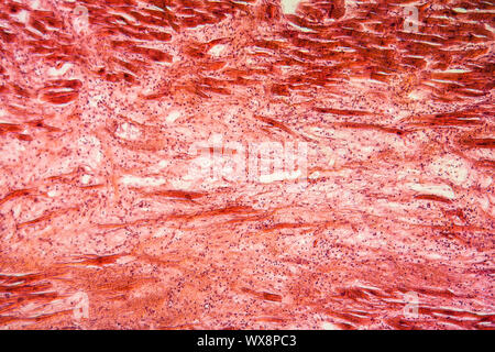 Cyst of the ovary diseased tissue 100x Stock Photo