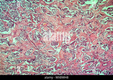 Thyroid scirrhous carcinoma diseased tissue 100x Stock Photo