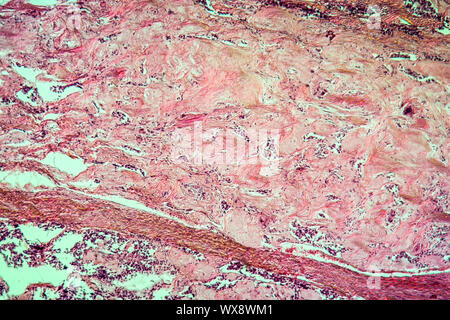 Thyroid scirrhous carcinoma diseased tissue 100x Stock Photo