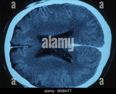 Computer tomography of the human head Stock Photo