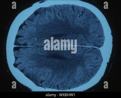 Computer tomography of the human head Stock Photo