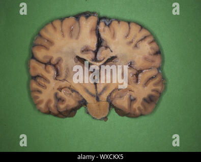 Human brain in longitudinal and cross section Stock Photo