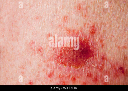 basal cell carcinoma skin cancer treatment with 5 percent fluorouracil medicine. This is the skin of a 58 year old woman. Stock Photo