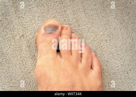 Nail hematoma. Take care of your feet. Pedicure and podiatry. Treatment of  bruise and fracture. Medicine concept. Trauma foot toes nails. Injury of toe  nail. Effects wearing uncomfortable footwear Stock Photo -