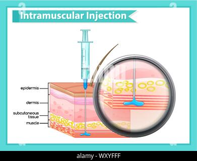 Human Skin Intramuscular Injection illustration Stock Vector Image ...