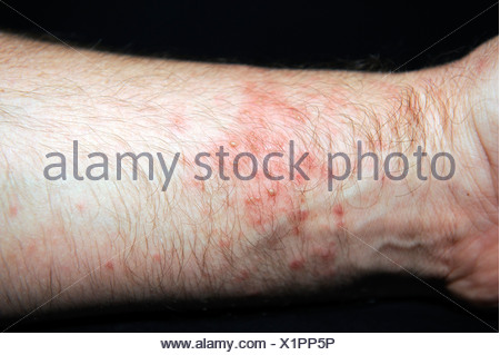 Very red, blistered skin, hives or urticaria after contact with sea ...