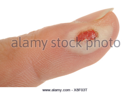 3rd degree burn blister 3rd degree burn blister