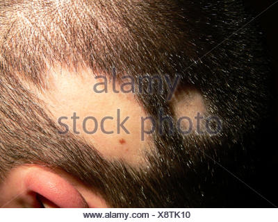 Alopecia areata Stock Photo: 2835373 - Alamy