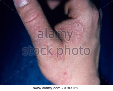 Fungus infection called Tinea manus on the hand. Also known as Stock ...