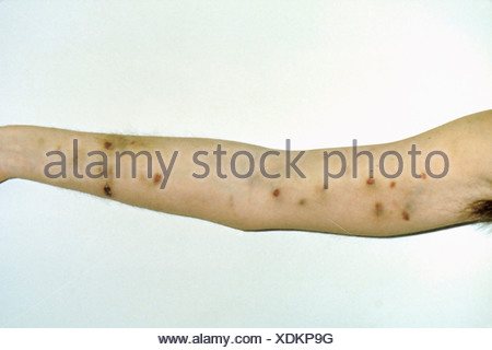 Kaposi's sarcoma on arm AIDS patient. Kaposi's sarcoma are common Stock ...