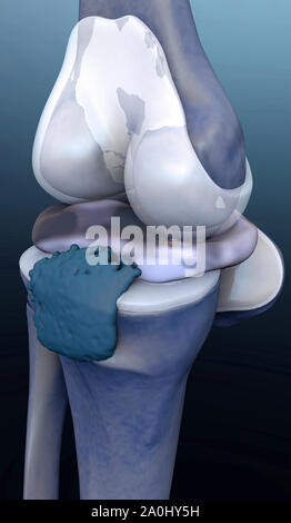 Die Gelenkzerstörung gerenderten 3D-Illustration, Knie schmerzen Abbildung Knie seitlich, 3D-Illustration knie Seite, Stockfoto