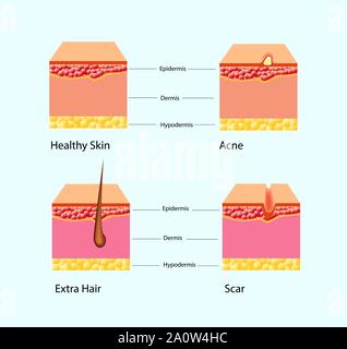 Vector Illustration der Arten der Haut Probleme isoliert Stock Vektor