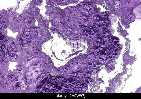 Schlecht differenzierte intestinale Adenokarzinom, Licht Schliffbild, Foto unter dem Mikroskop Stockfoto