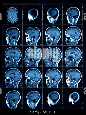 In Scheiben geschnitten Abschnitt CT Scan eines menschlichen Kopfes, zeigt die Großhirnrinde durch die SINUS-Kavitäten. Stockfoto