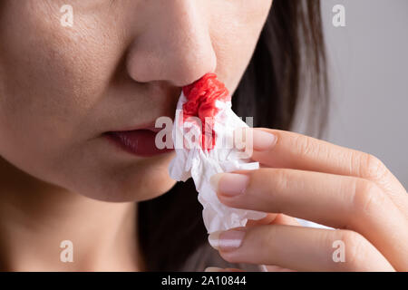 Nasenbluten, eine junge Frau mit Nasenbluten und mit Seidenpapier für die Blutung zum Stillstand. Gesundheitswesen und Medizinische Konzept. Stockfoto