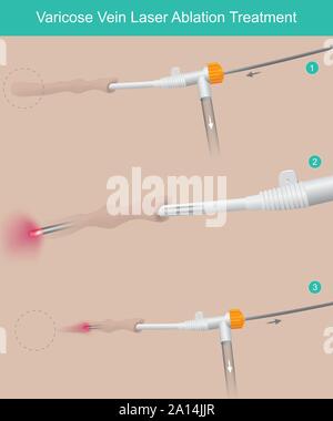 Krampfadern sind oberflächliche Venen, die erweiterten geworden sind, und verdreht, kann die Wärme der Laserstrahl behandelt werden. Stock Vektor