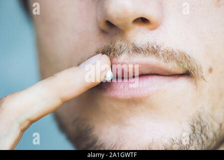 Herpes auf den Lippen des jungen Mannes. Man schmiert Herpes mit Herpes Creme. Stockfoto