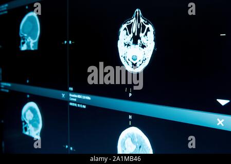 Monitor zeigt die Magnetresonanztomographie (MRT) Scans des Gehirns. Stockfoto