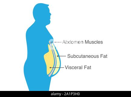 Viszerales Fett und subkutane Fett, um ihre Taille ansammeln. Abbildung über medizinische Diagramm. Stock Vektor