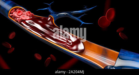 3D-Darstellung von tiefen Venenthrombosen oder Blutgerinnsel. Embolie. Stockfoto