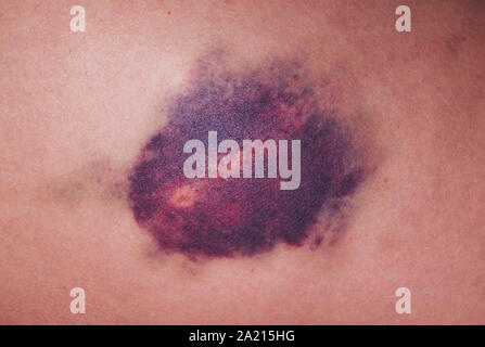 Verletzungen des Kniegelenkes. Großen blauen Fleck am Knie Stockfoto