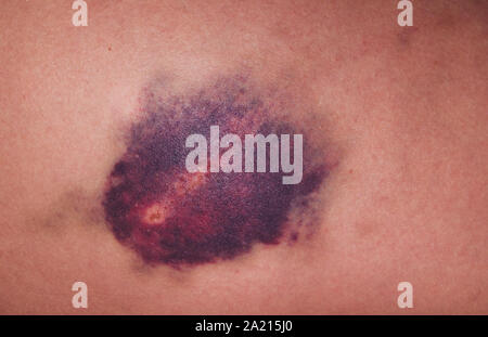 Verletzungen des Kniegelenkes. Großen blauen Fleck am Knie Stockfoto