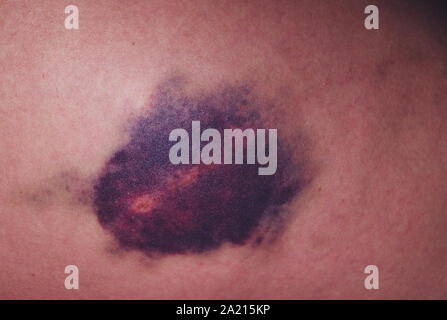 Verletzungen des Kniegelenkes. Großen blauen Fleck am Knie Stockfoto