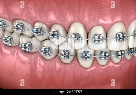 Zähne mit metallverstrebungen im Zahnfleisch. Medizinisch genauen zahnmedizinischen 3D-Darstellung Stockfoto