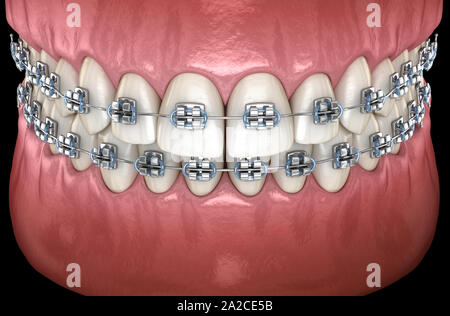 Zähne mit metallverstrebungen im Zahnfleisch. Medizinisch genauen zahnmedizinischen 3D-Darstellung Stockfoto