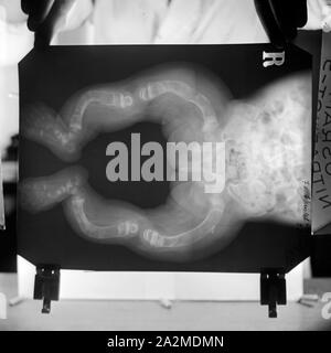 Reproduktion eines Röntgenbilds der deformierten Knochen eines Kleinkinds, Deutschland 1930er Jahre. Reproduktion von einem röntgenbild von verformten Beinknochen eines Kindes, Deutschland 1930. Stockfoto