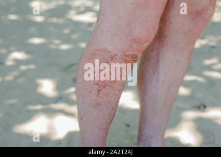 Schließen Sie bis zu den Beinen des erwachsenen Mannes mit Weiden Knie mit Blut auf der Haut, Notfall Unfall Stockfoto