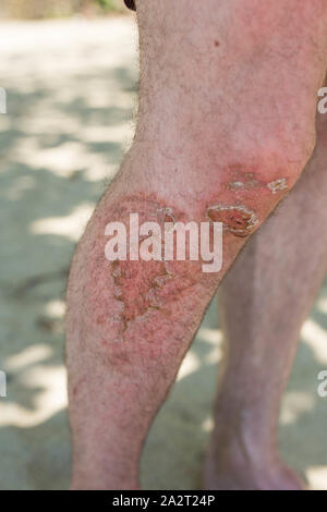 Schließen Sie bis zu den Beinen des erwachsenen Mannes mit Weiden Knie mit Blut auf der Haut, Notfall Unfall Stockfoto