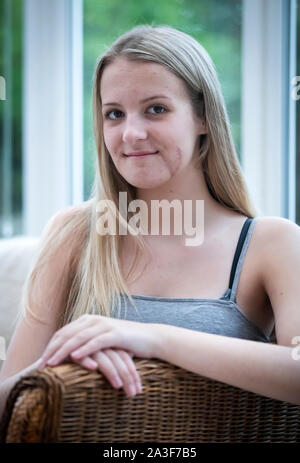 Emily Eccles, an ihrem Haus in Yorkshire, nachdem Sie erlitt eine der schlimmsten Gesichtsverletzungen ärzte gesehen haben, vor einem Krieg, in einem Reiten Unfall. Stockfoto